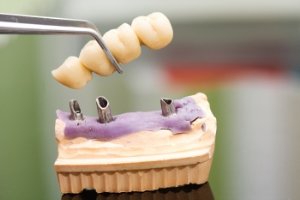 Dental Implants at North Hill Denture Clinic